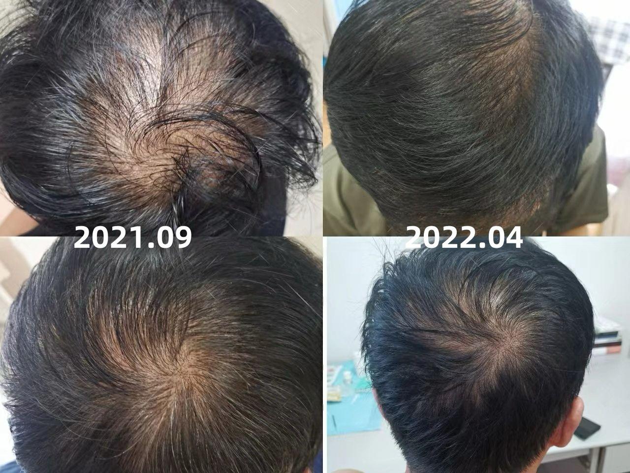 XOM Hair Growth Result 2