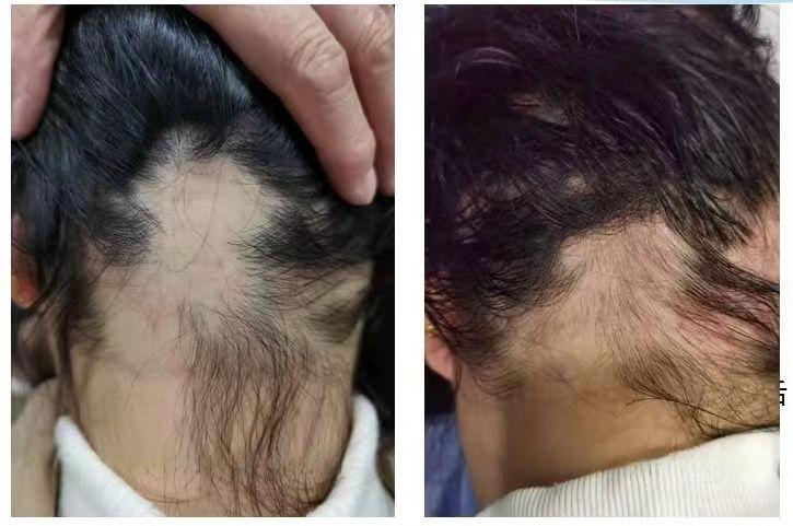 XOM Hair Growth Result 3