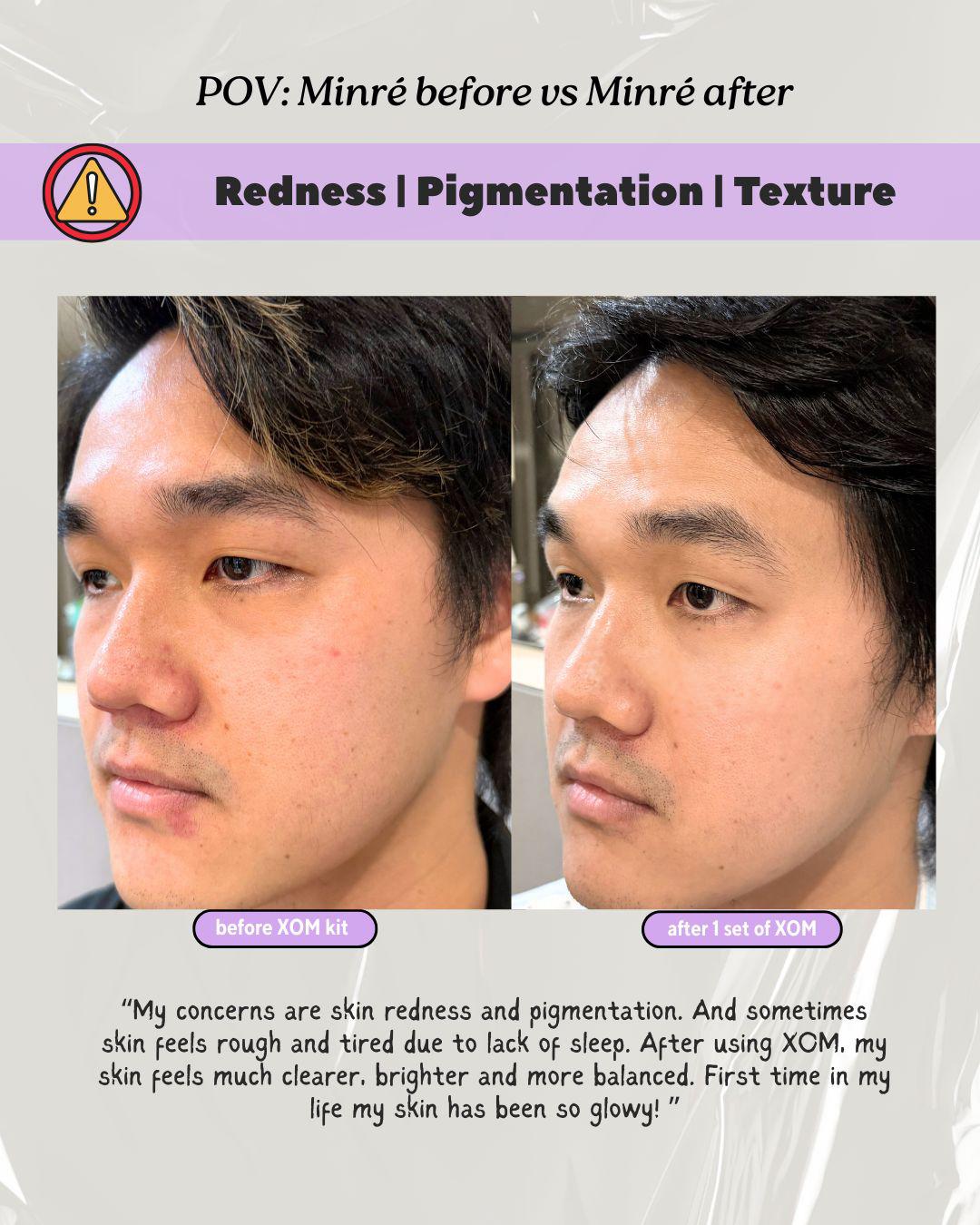 Before & After: Redness, Pigment, Texture