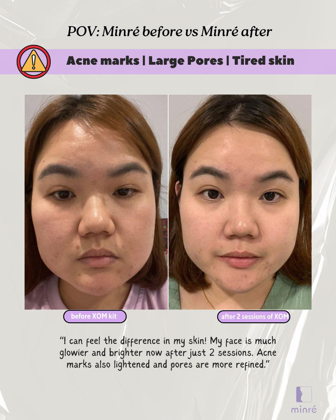 Before & After: Acne Marks, Tired Skin
