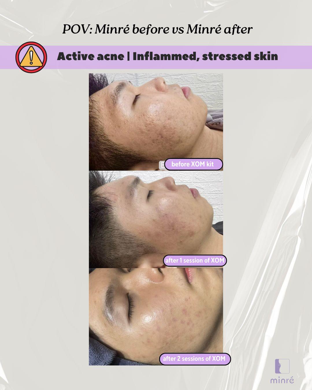 Before & After: Acne Scar and Acne