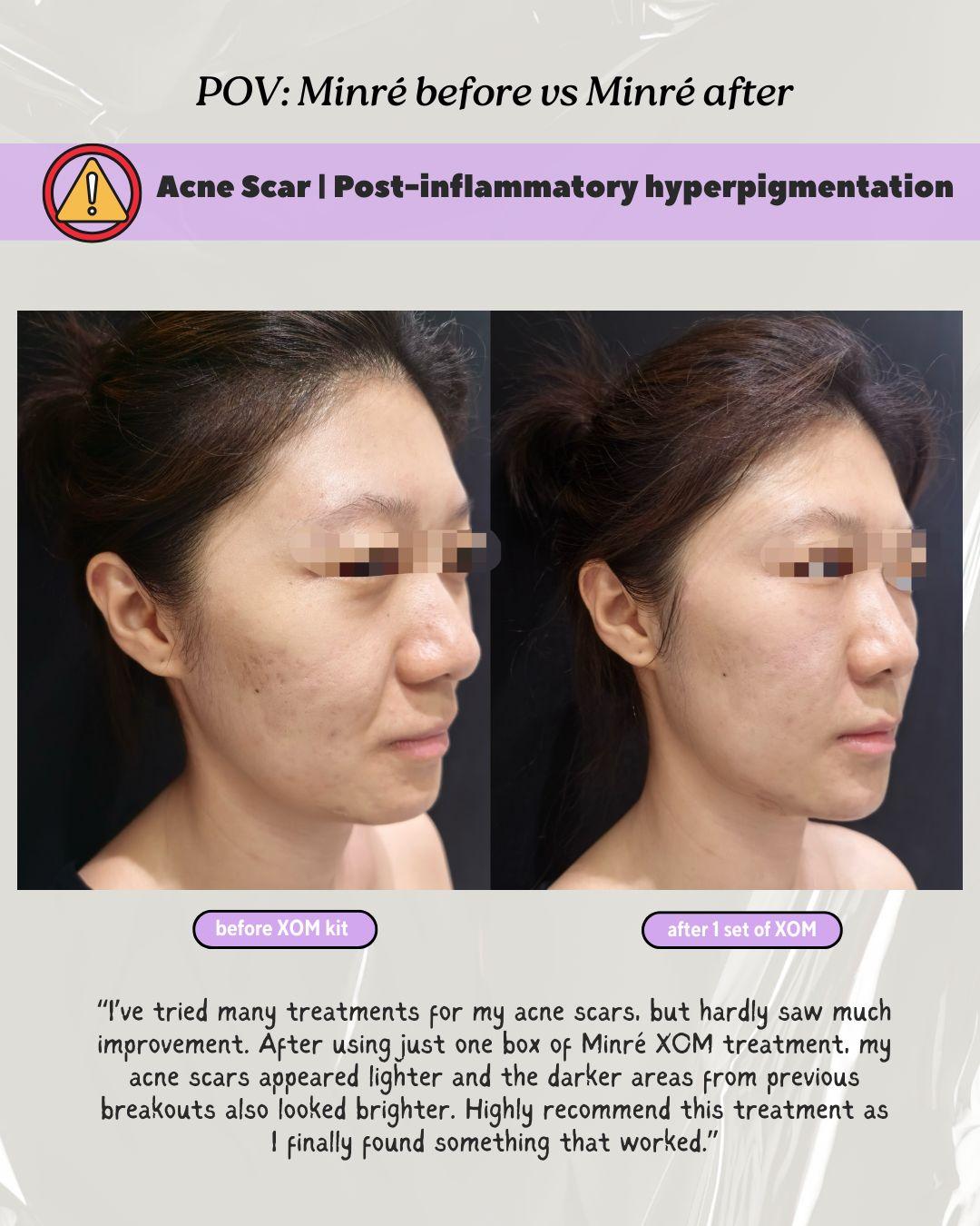 Before & After: Acne Scars, Post-Inflammatory Hyperpigmentation