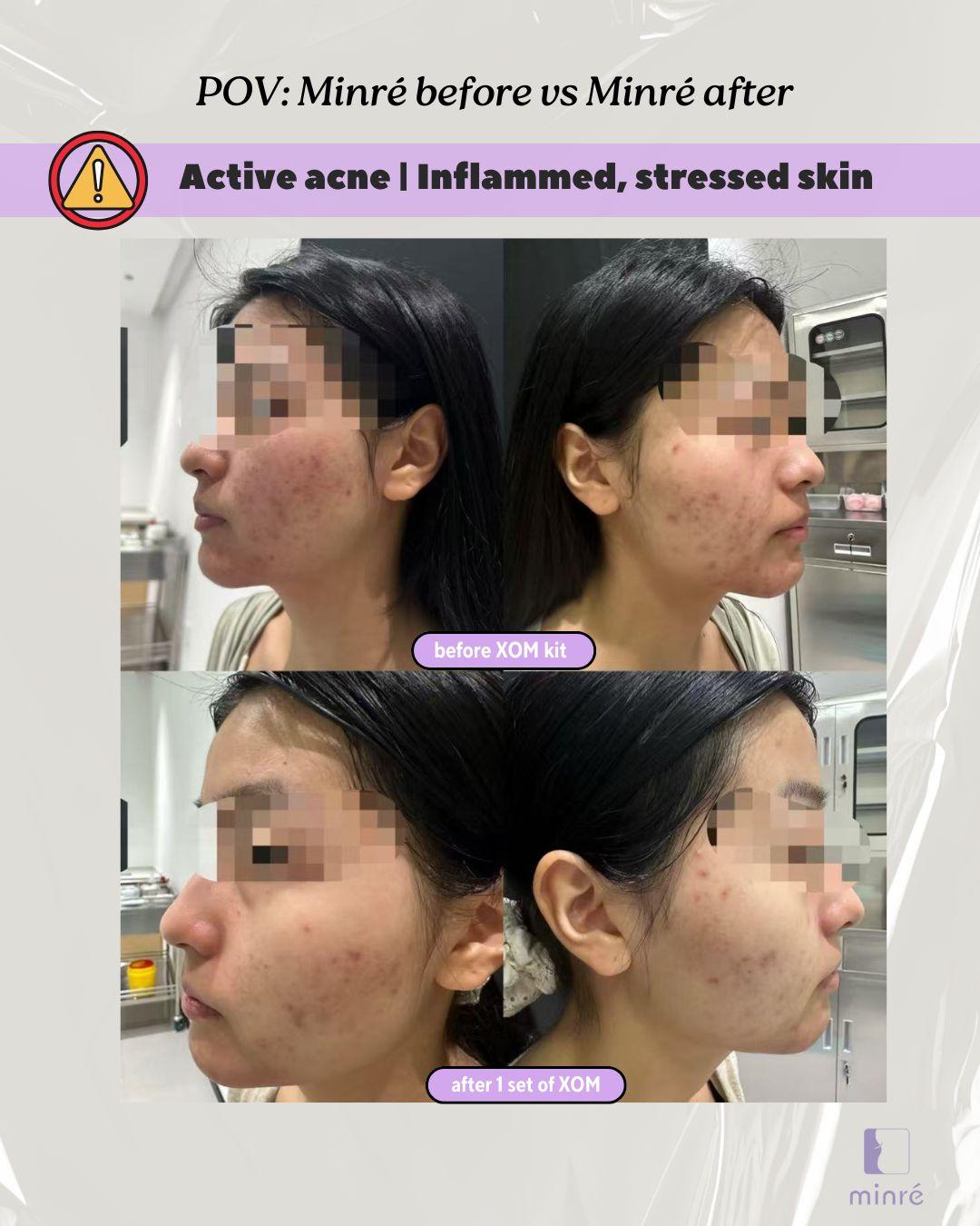 Before & After: Active Acne Sensitive Skin