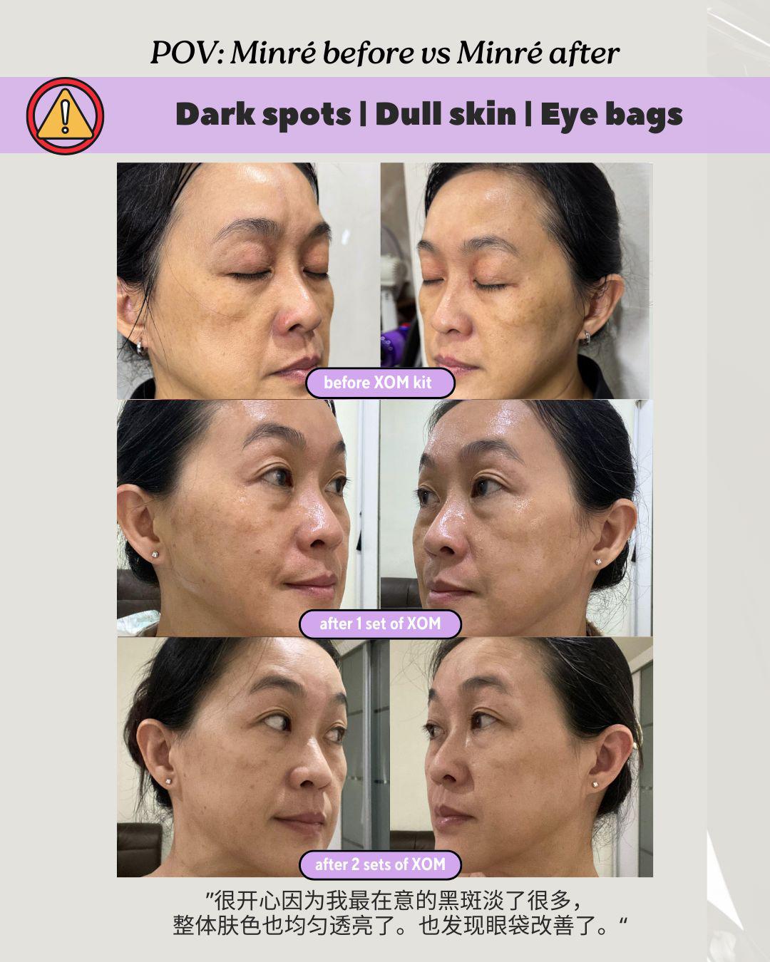 Before & After: Dark Spots, Eyebag