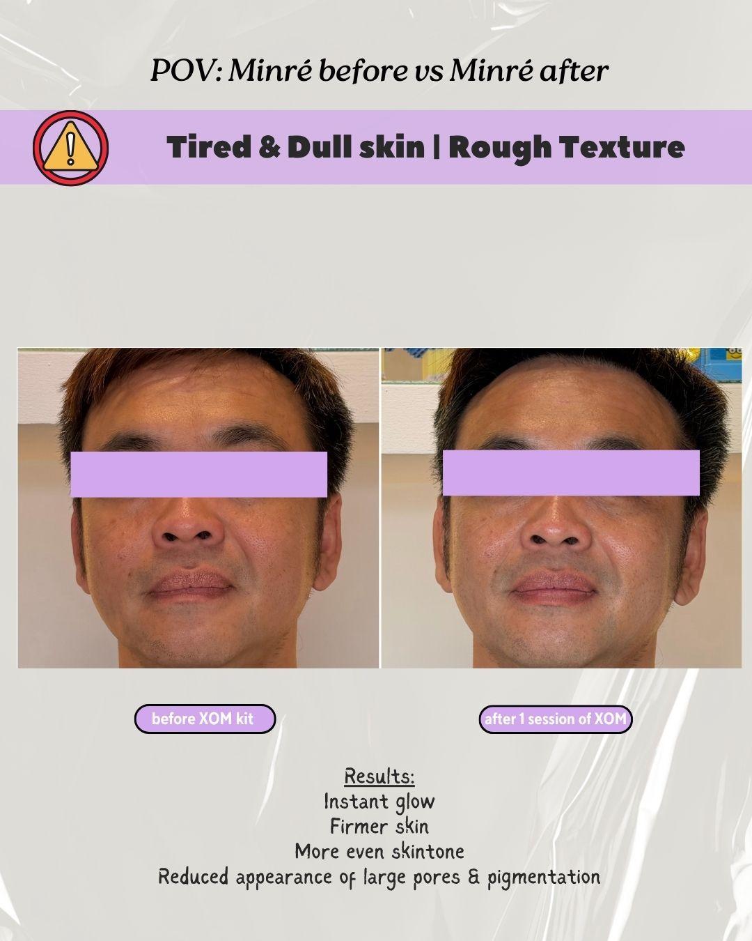 Before & After: Dull Rough Skin