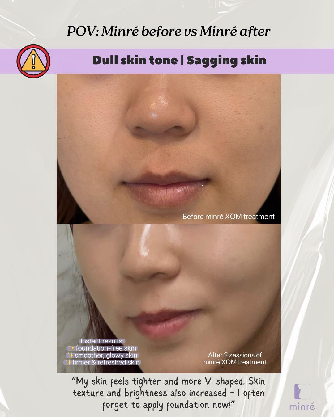 Before & After: Dull Skin, Lifting