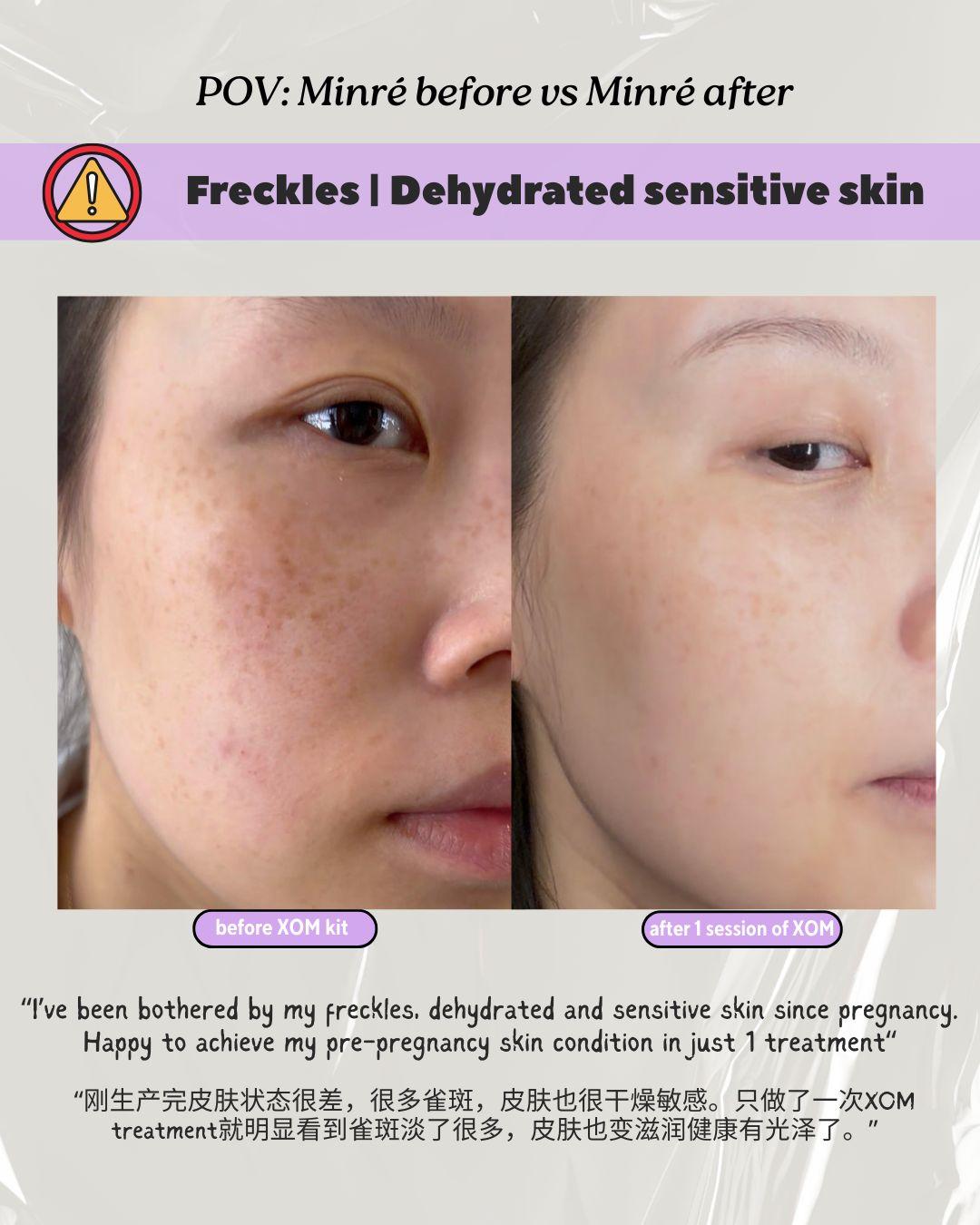 Before & After: Freckles, Dehydrated Post-Pregnancy Skin