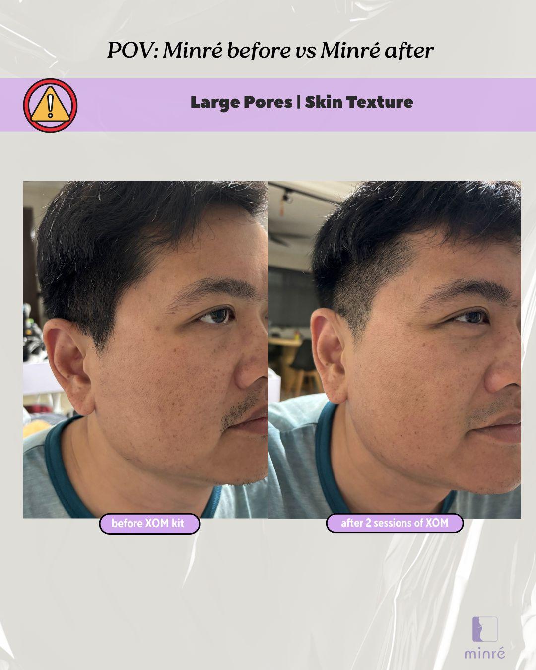 Before & After: Large Pores, Skintone