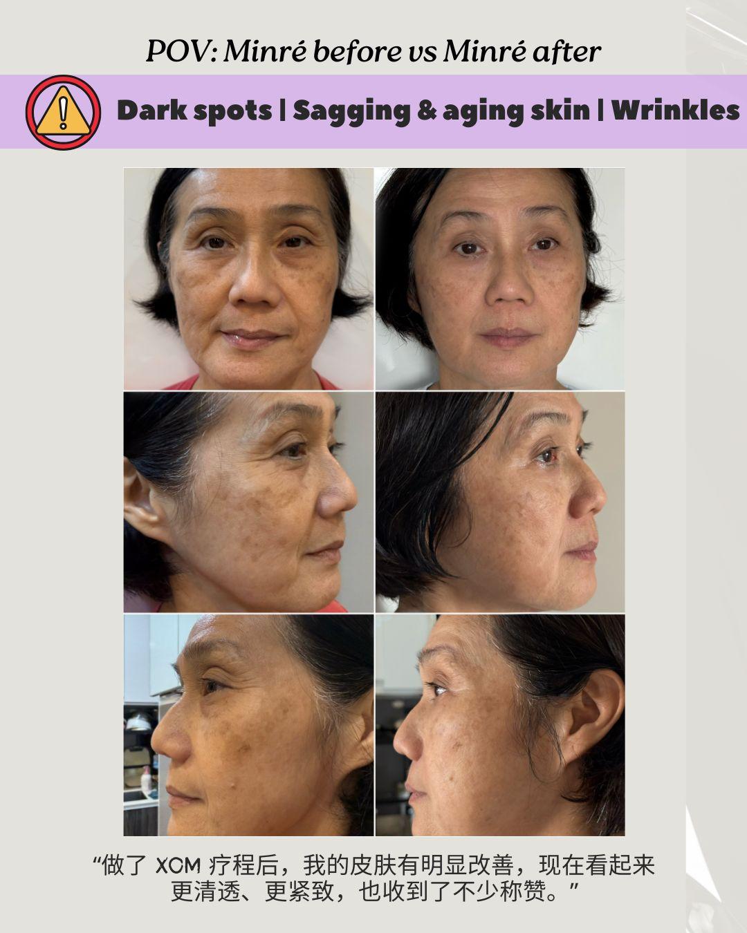 Before & After: Pigment and Wrinkles
