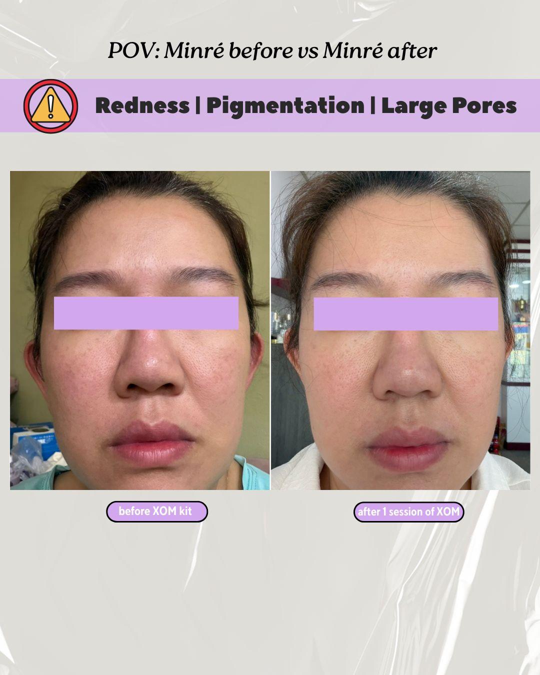 Before & After: Pigmentation and Pores