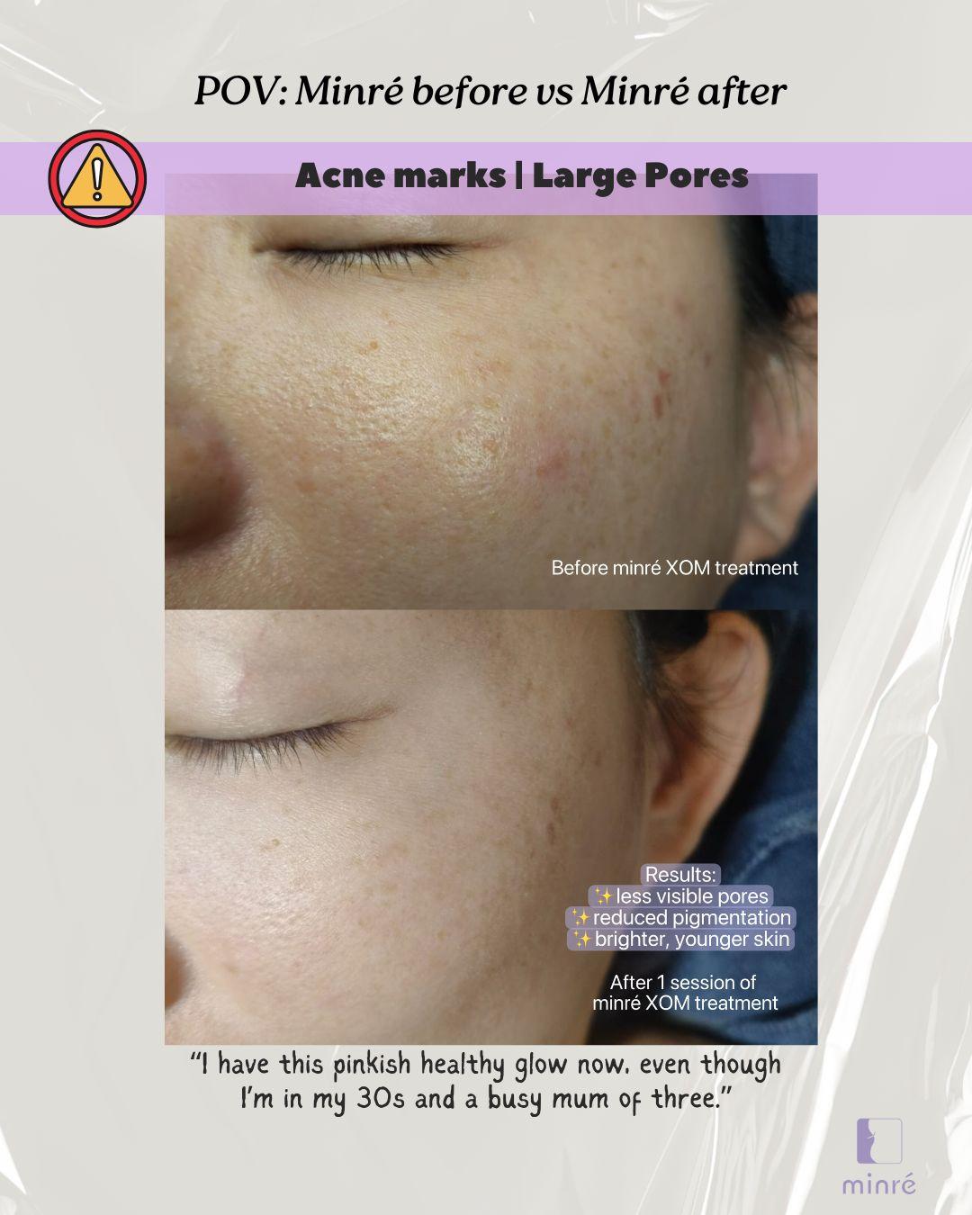 Before & After: Pores, Pigment