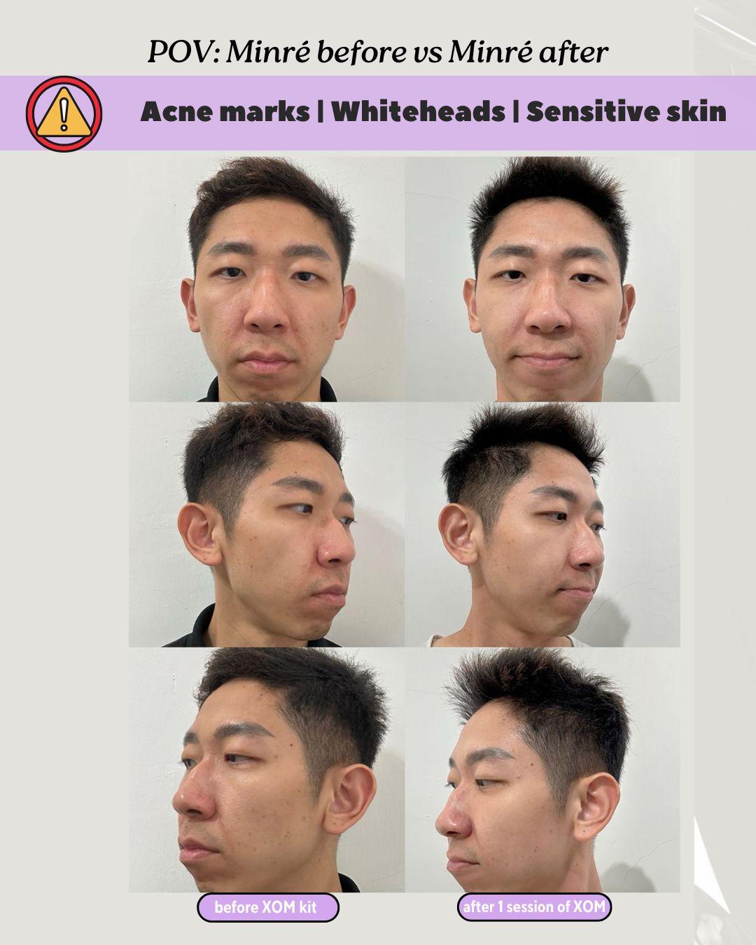 Before & After: Whiteheads, Sensitive Skin