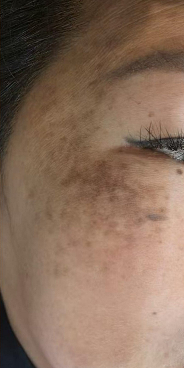 After treatment - Case Study 1